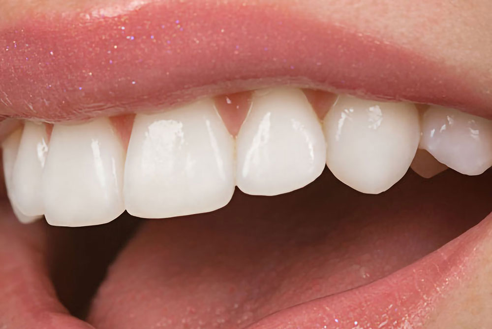 What does dental whitening consist of